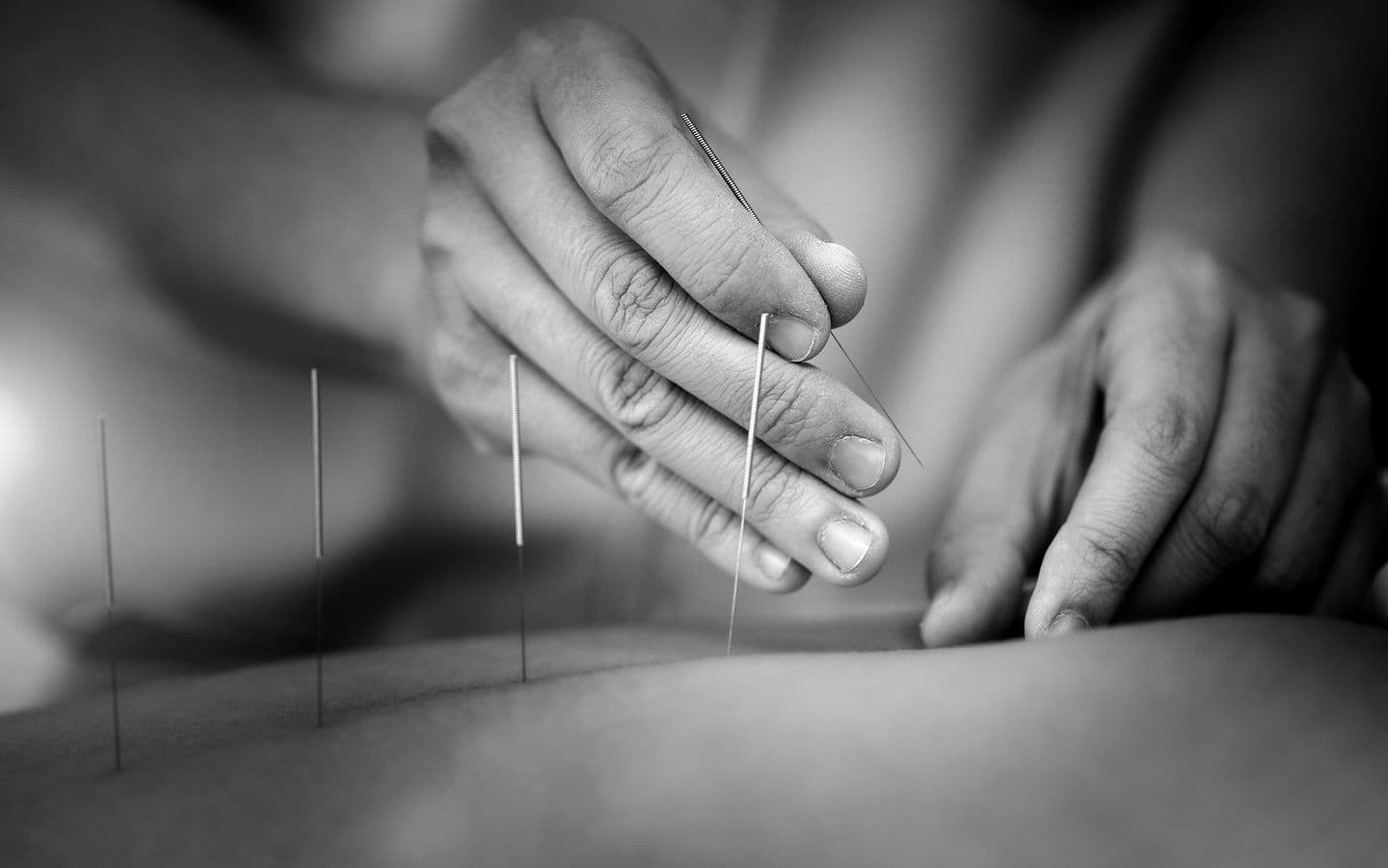 Acupuncture
