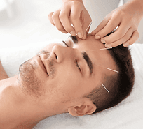 Acupuncture
